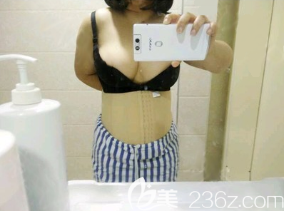 成都西區(qū)醫(yī)院腰腹吸脂術(shù)后效果 成都西區(qū)醫(yī)院腰腹吸脂術(shù)后效果