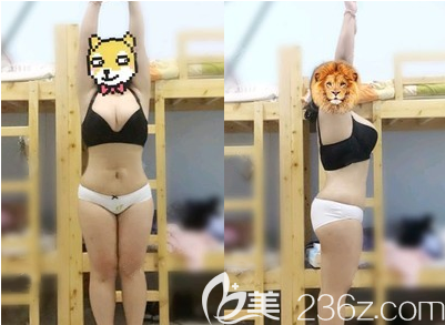 毛健清腰腹吸脂術(shù)后一個(gè)月恢復(fù)效果 毛健清腰腹吸脂術(shù)后一個(gè)月恢復(fù)效果