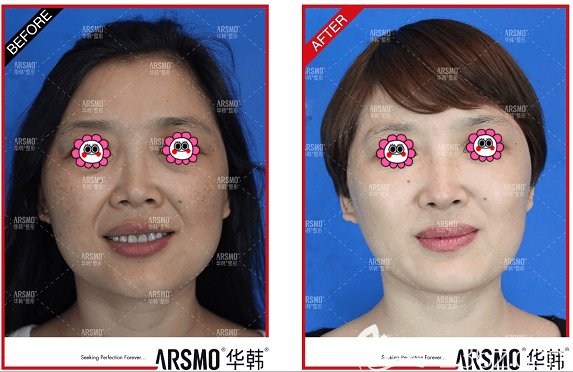 北京華韓西班牙王室光白針美白祛斑案例