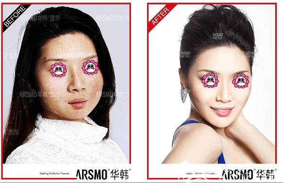 北京華韓西班牙王室光白針美白祛斑案例