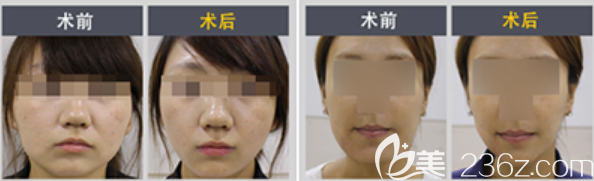 韓國hansen整形外科辛元宰院長面部吸脂真人案例