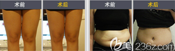 韓國hansen整形外<!--<i data=20240703-sp></i>-->腿吸脂與腰腹吸脂案例