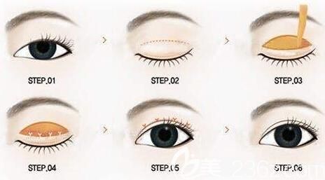 割完雙眼皮后恢復(fù)期必須要熬過的5大階段