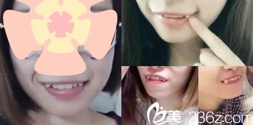 我在泉州維樂口腔戴金屬牙套前的牙齒照 我在泉州維樂口腔戴金屬牙套前的牙齒照