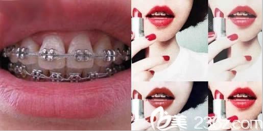 我在泉州維樂口腔做金屬牙套矯正中照片 我在泉州維樂口腔做金屬牙套矯正中照片