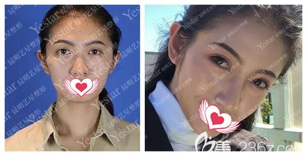 金輝做肋軟骨隆鼻+耳軟骨墊鼻尖案例效果