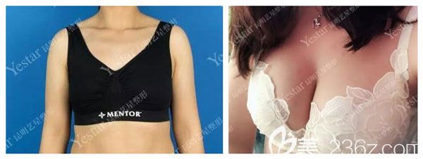 做硅膠假體隆胸案例效果對比圖