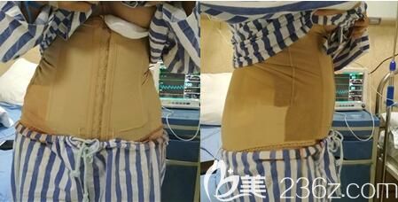 李正強(qiáng)腰腹吸脂手術(shù)術(shù)后即刻