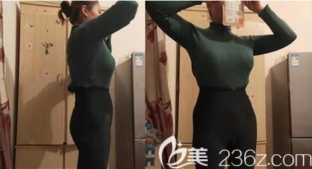 腰腹抽脂術(shù)后2個(gè)月恢復(fù)效果