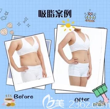 吸脂減肥的原理及真人案例介紹