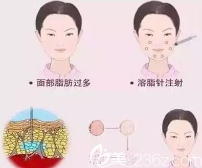 通過微整注射達到瘦臉目的，使用多的就是