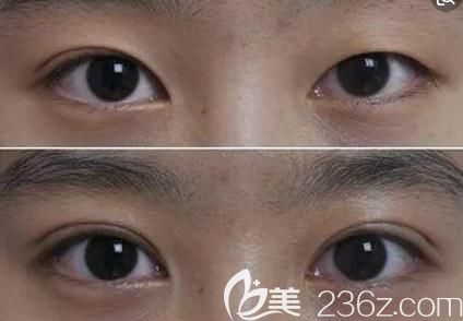 雙眼皮手術(shù)