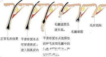 冰點脫毛術(shù)后注意事項