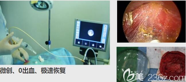 內(nèi)窺鏡技術(shù)下<!--<i data=20240703-sp></i>-->取出隆胸假體 內(nèi)窺鏡技術(shù)下<!--<i data=20240703-sp></i>-->取出隆胸假體