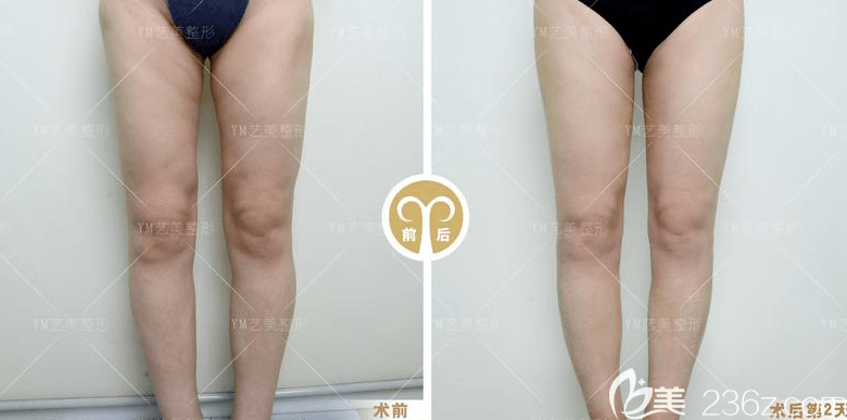 北京藝美王東醫(yī)生腿部吸脂失敗修復案例