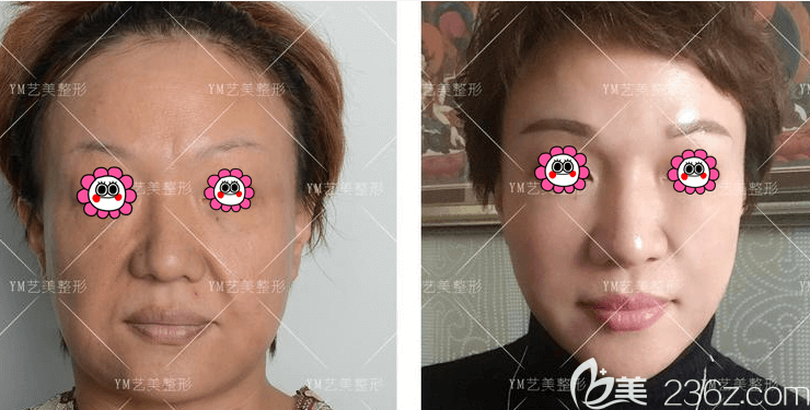 北京藝美王東醫(yī)生面部吸脂失敗修復案例