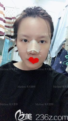 在承德美天做鼻綜合術(shù)后3天慢慢消腫 在承德美天做鼻綜合術(shù)后3天慢慢消腫