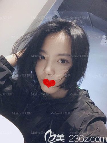 在承德美天做鼻綜合術(shù)后1個(gè)月恢復(fù)高挺 在承德美天做鼻綜合術(shù)后1個(gè)月恢復(fù)高挺