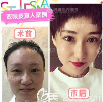 眼部綜合手術(shù)案例