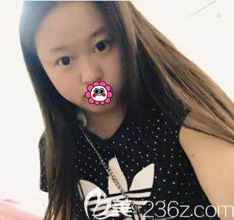 在北京藝美做眼綜合和鼻綜合前樣子 在北京藝美做眼綜合和鼻綜合前樣子