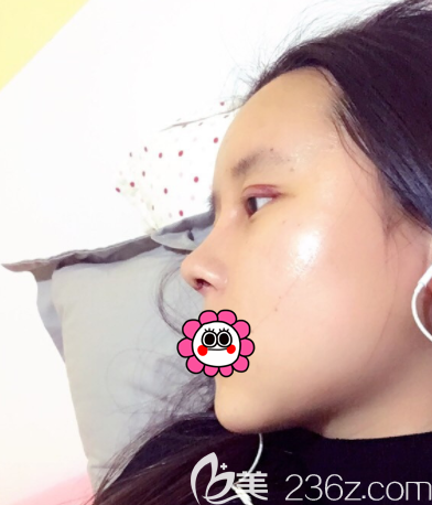 鞏敏醫(yī)生給我做眼綜合和鼻綜合第3天樣子 鞏敏醫(yī)生給我做眼綜合和鼻綜合第3天樣子