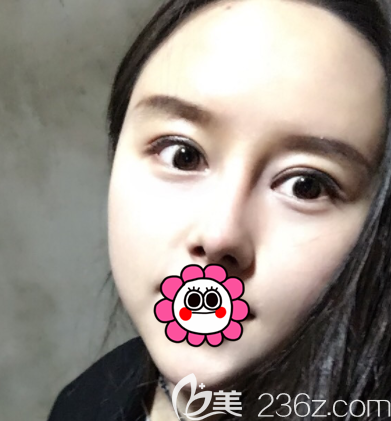 在北京藝美做眼綜合和鼻綜合第38天效果 在北京藝美做眼綜合和鼻綜合第38天效果
