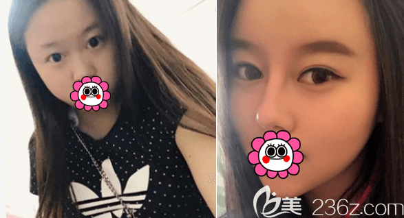 北京藝美鞏敏醫(yī)生眼綜合和鼻綜合案例 北京藝美鞏敏醫(yī)生眼綜合和鼻綜合案例