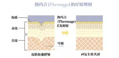 熱瑪吉除皺原理 熱瑪吉除皺原理
