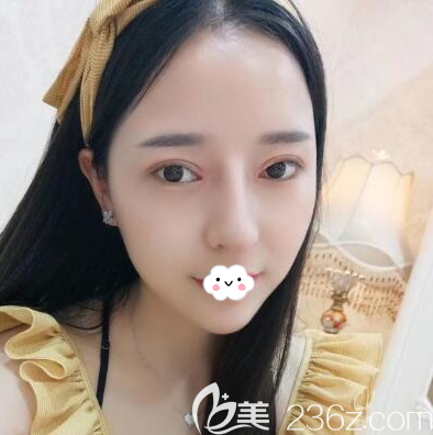 鐘正強雙眼皮隆鼻一個月恢復(fù)效果圖 鐘正強雙眼皮隆鼻一個月恢復(fù)效果圖