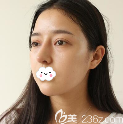 切開雙眼皮+鼻綜合術(shù)后9天恢復(fù)圖 切開雙眼皮+鼻綜合術(shù)后9天恢復(fù)圖