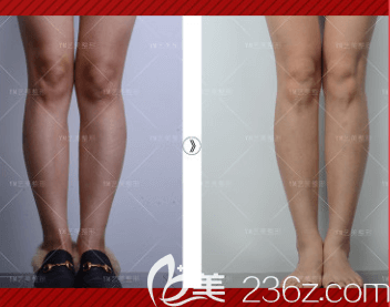 北京藝美王東醫(yī)生O型腿矯正案例