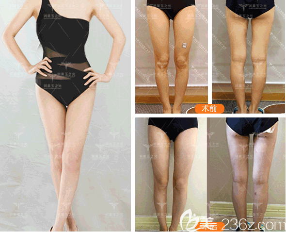 北京潤美玉之光王明利醫(yī)生O型腿矯正案例