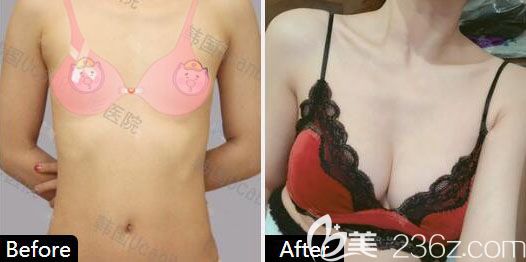 韓國魔滴芯片假體隆胸UcanB金駿昊院長案例