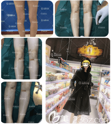 北京卓顏蕊麗趙禹翔OX型腿矯正案例