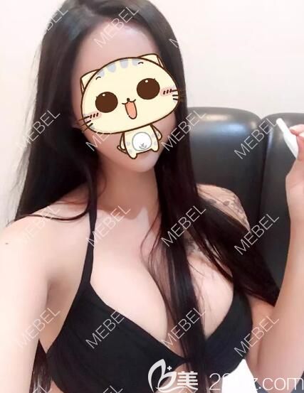 32a的揚(yáng)州本地姑娘到美貝爾做了自體脂肪移植豐胸術(shù)后成活不錯(cuò) 三個(gè)月穿比基尼已經(jīng)有溝兒了