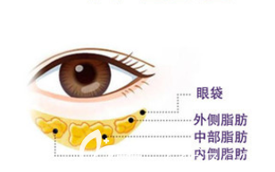 眼袋示意圖