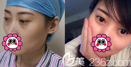 不開刀祛眼袋案例