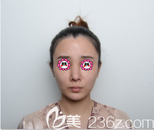 在北京藝美做鼻部異物取出術(shù)前樣子 在北京藝美做鼻部異物取出術(shù)前樣子