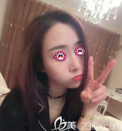 北京藝美范憲紅醫(yī)生鼻部異物取出術(shù)案例 北京藝美范憲紅醫(yī)生鼻部異物取出術(shù)案例