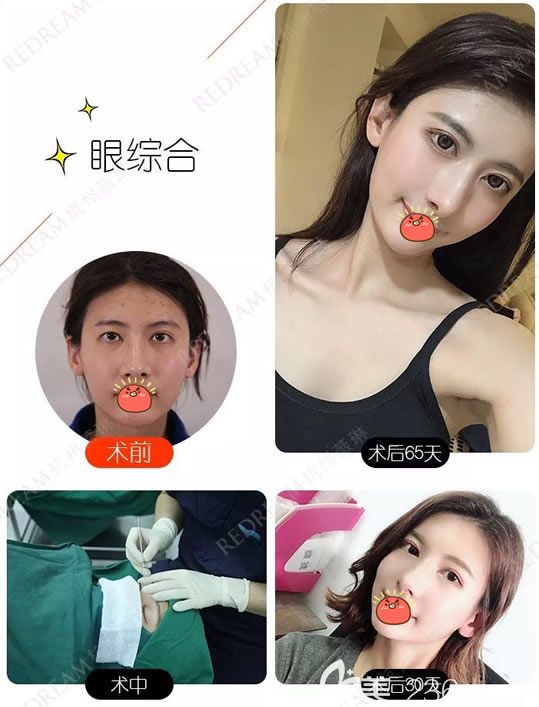 杭州薇琳索慧君割雙眼皮案例