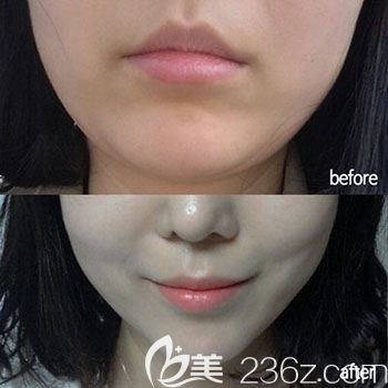 崔永澤院長(zhǎng)注射瘦臉案例 崔永澤院長(zhǎng)注射瘦臉案例