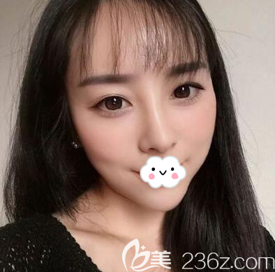 前段時(shí)間做活動(dòng)，我當(dāng)成都美極模特找石曉軍做的全臉玻尿酸填充加線雕隆鼻效果圖