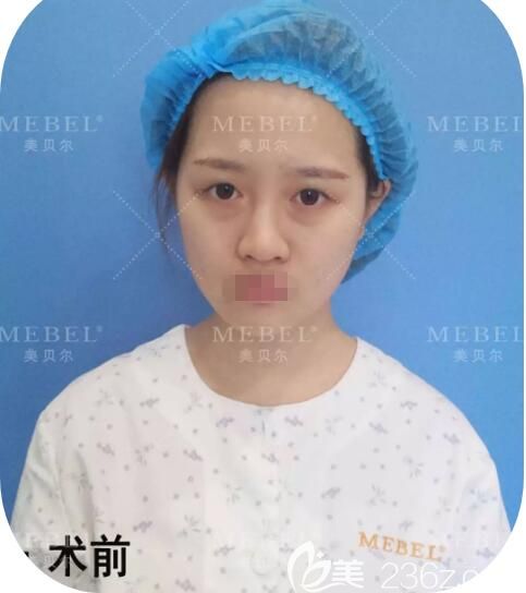 面診揚州美貝爾做眼鼻整形術前樣子 面診揚州美貝爾做眼鼻整形術前樣子