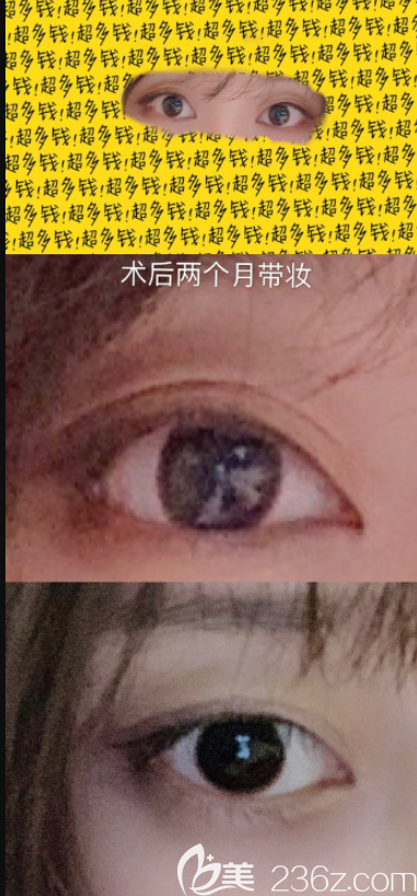 術(shù)后2個(gè)月眼角下<span style=