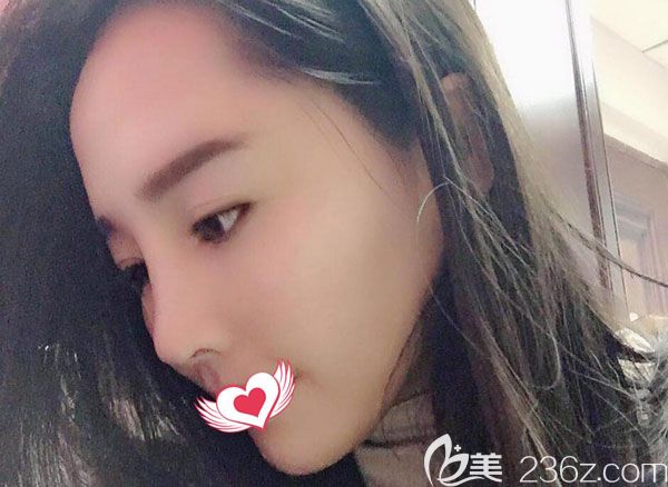 耳軟骨隆鼻第7天拆線鼻子線條流暢，鼻尖微微上翹
