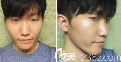 在韓國本愛做鼻綜合手術前 在韓國本愛做鼻綜合手術前