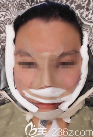 在韓國本愛做鼻綜合手術后1天 在韓國本愛做鼻綜合手術后1天