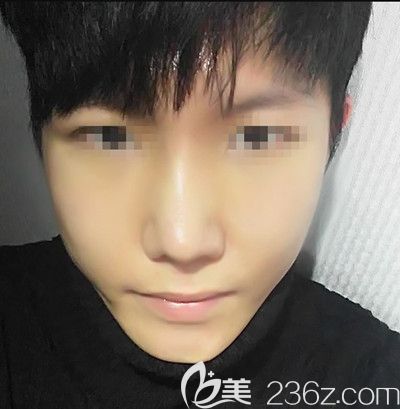 在韓國本愛做鼻綜合手術后1個月 在韓國本愛做鼻綜合手術后1個月