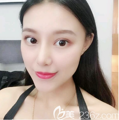 去深圳米蘭柏羽找朱武根做完鼻綜合鼻翼縮小后感覺醫(yī)院挺正規(guī)靠譜的,醫(yī)生審美也不錯