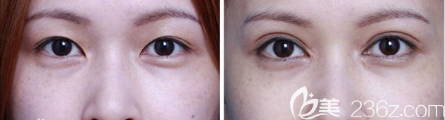 惠州伊麗莎白金鴻醫(yī)生雙眼皮手術(shù)案例